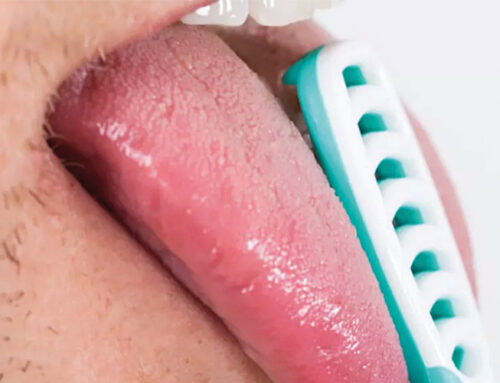 Zungenreinigung – Warum Sie auch Ihre Zunge putzen sollten